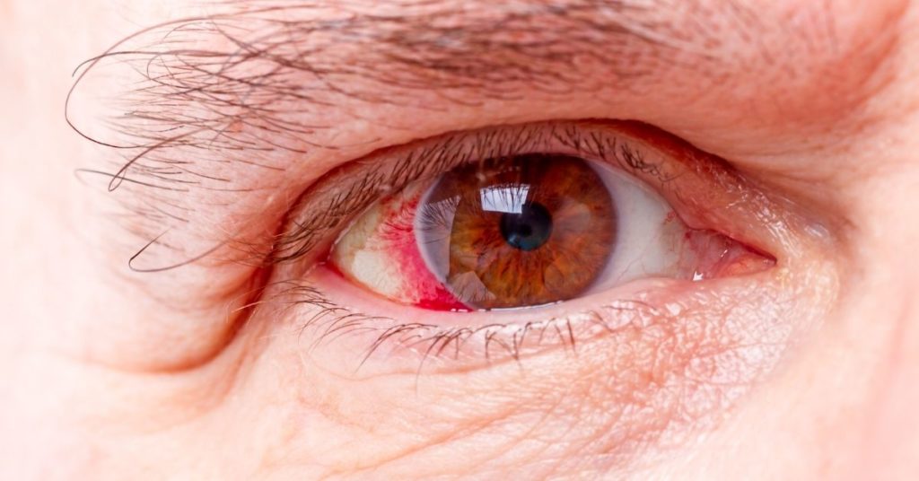 Hiper Iris